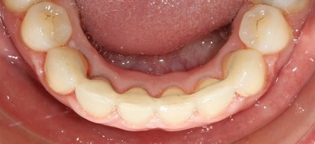 Contention Orthodontique Mandibule